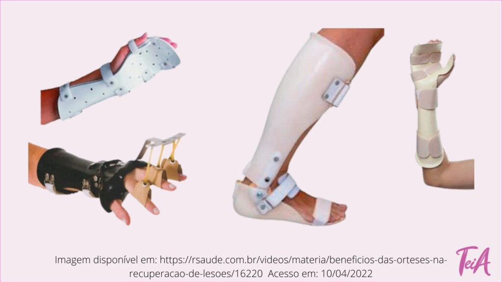 Órteses são dispositivos externos destinados a corrigir e/ou melhorar a função de um segmento do corpo.